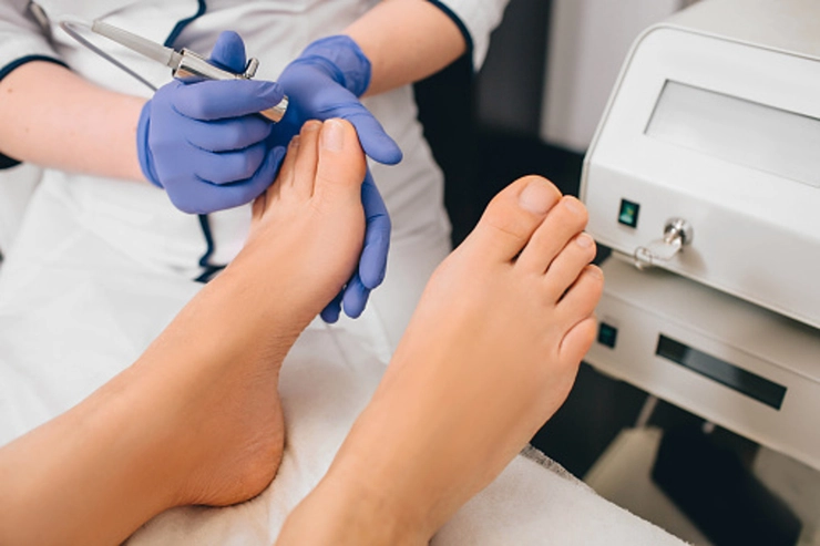 picioarele unui pacient la tratament pentru unghii