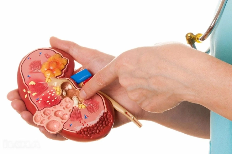 medic care indica cu degetul spre un mulaj al rinichilor