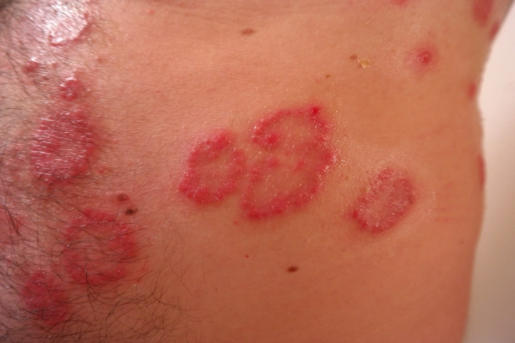 eruptie cutanata pe pielea unei persoane provocate de eritem polimorf