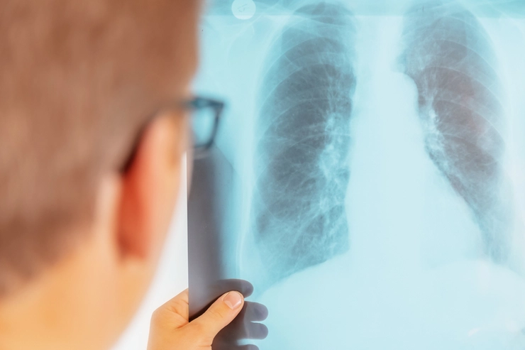 medic care priveste un rezultat de la rentgen cu plamanii unei persoane