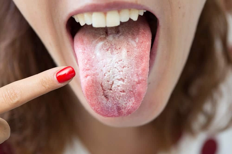 limbă afectată de candidoza bucală
