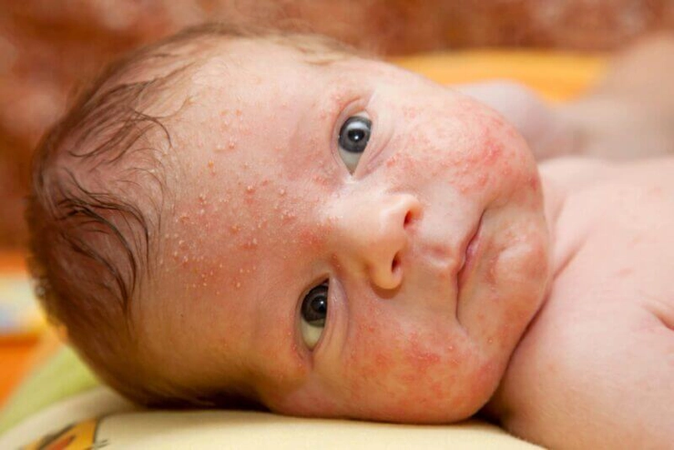 pielea unui bebelus afectata de keratoza seboreica