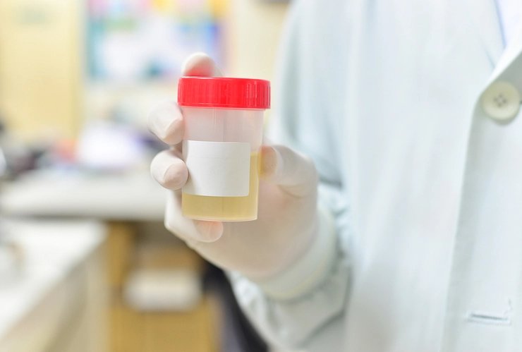 recipient cu urină pentru analize