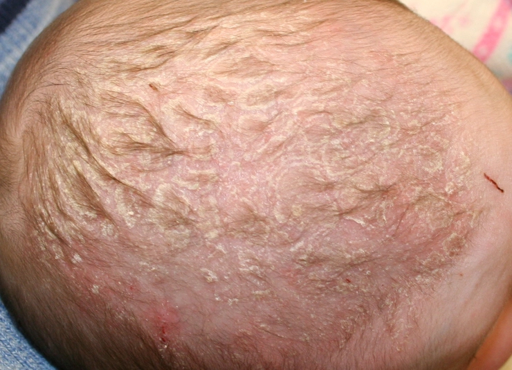 pielea unui bebelus afectata de keratoza seboreica