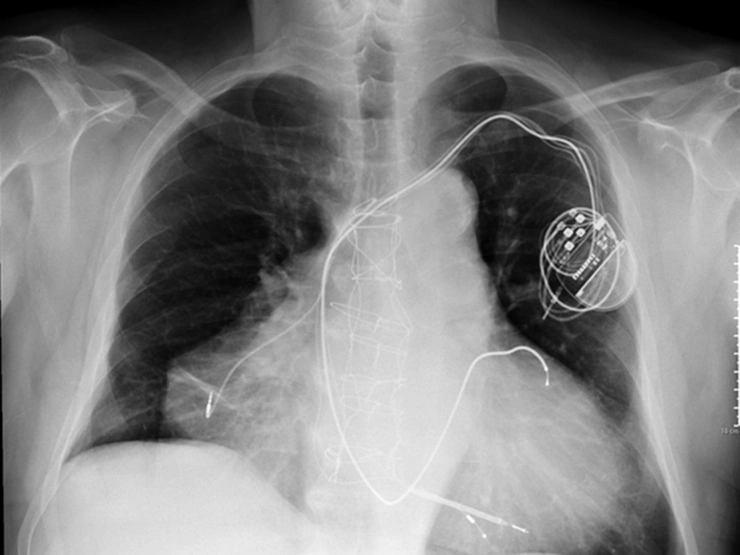 radiografie persoana cu doua inimi