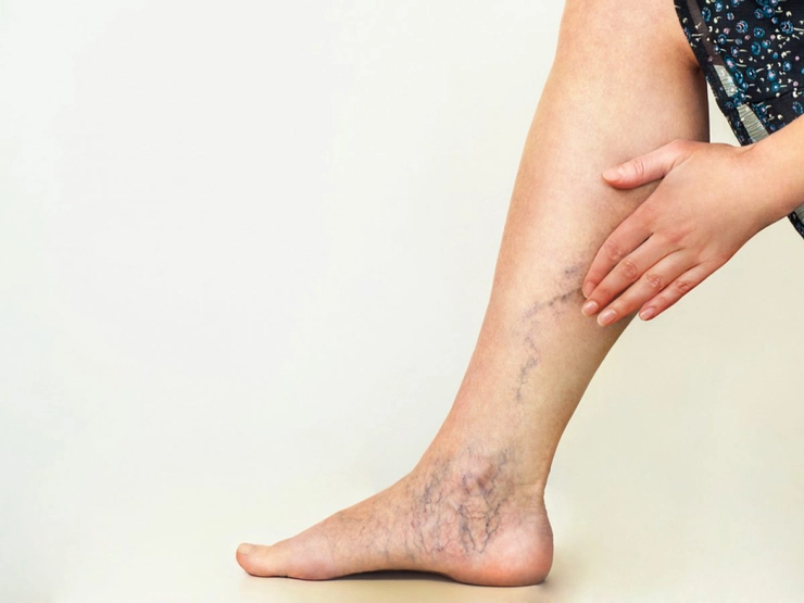 femeie care se tine de piciorul ei care afectat de tromboza