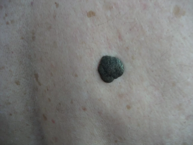 eruptie cutanata pe pielea unei persoane provocata de keratoza seboreica