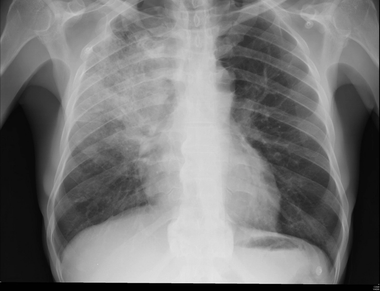 o radiografie pulmonară