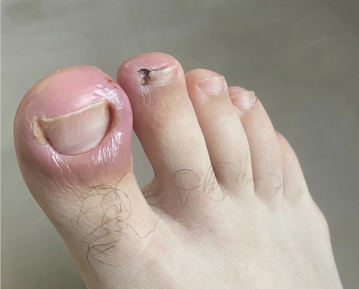 unghie de la picior incarnata
