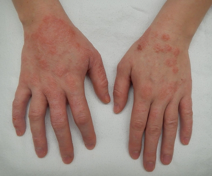 eruptie cutanata pe mainele a unei persoane cauzata de o alergie a pielii