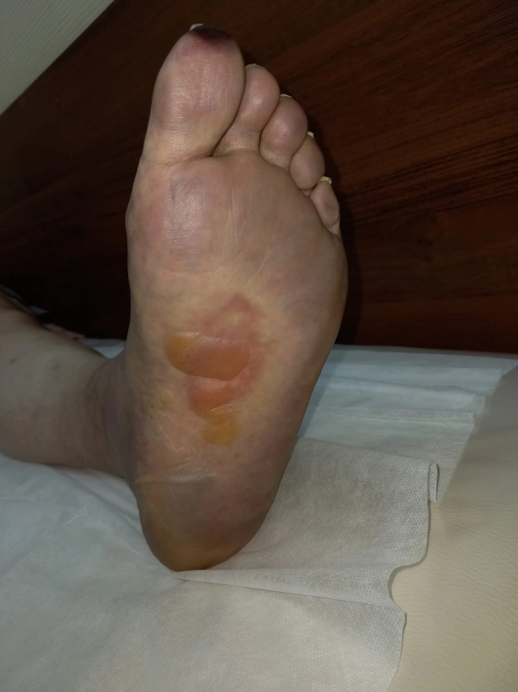 piciorul unei persoane afectat de cangrena