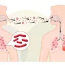 Cum se transmite tuberculoza pulmonară. Adevărul din spatele stigmei și miturilor care înconjoară această boală