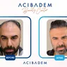 Acibadem Beauty Center Locul Sigur din Turcia Pentru Transplantul de Păr