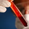Testul de sânge revoluționar Poate prezice riscul de reapariție a cancerului de sân cu 3 ani înainte